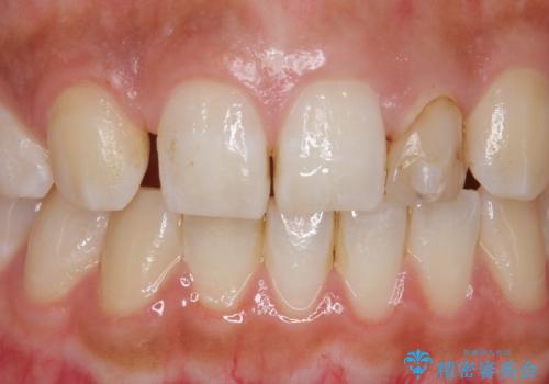 変色した前歯をキレイにしたい ジルコニアクラウンでの修復の症例 治療前