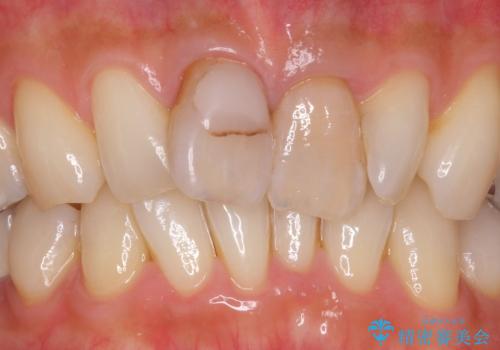 前歯をキレイにしたい ジルコニアクラウンでの治療の治療前