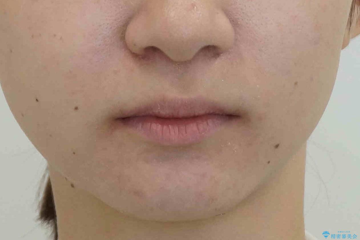 他3軒で4本抜いてワイヤー矯正と言われた 1本の抜歯でマウスピース矯正で治療可能ですの治療後(顔貌)