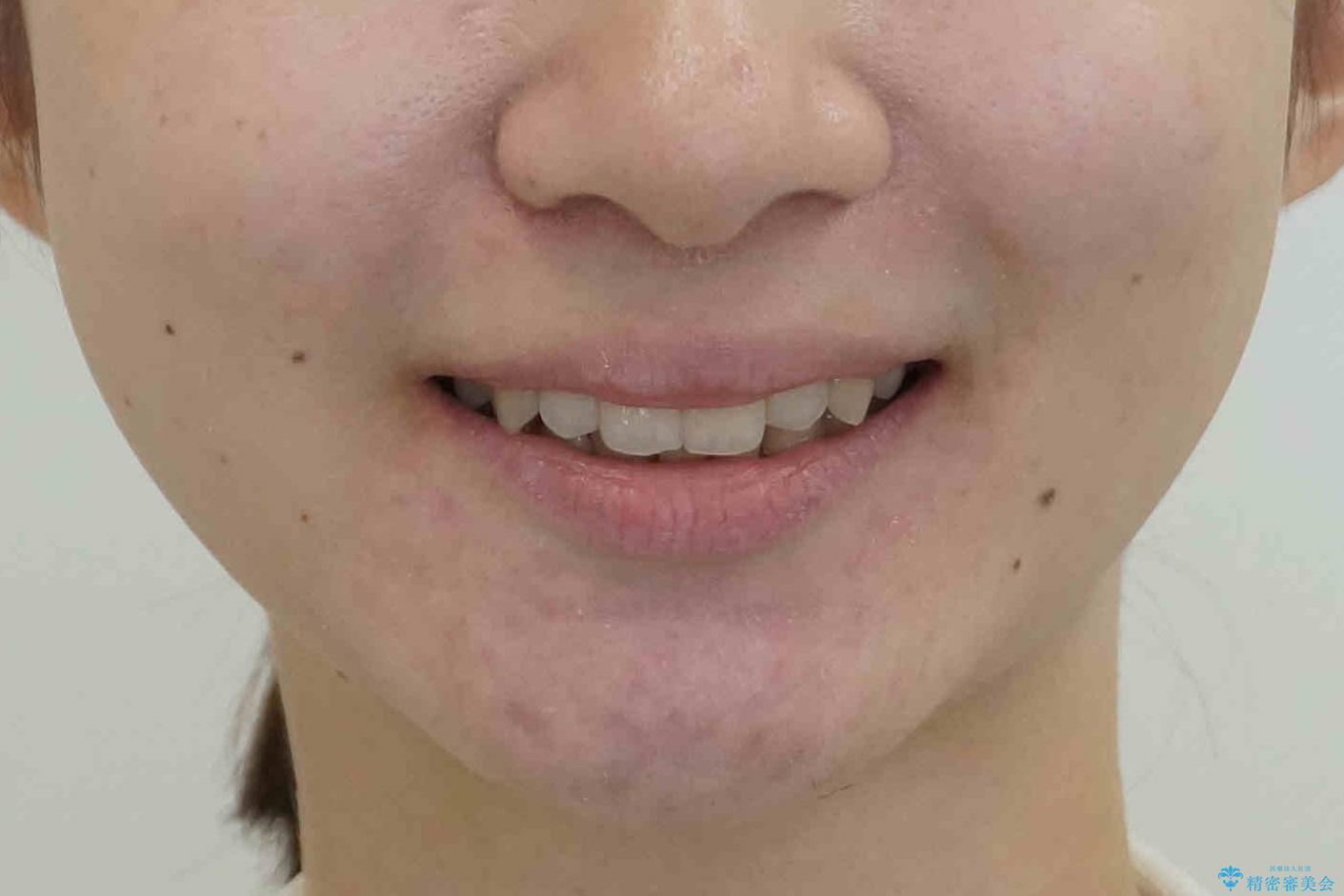 他3軒で4本抜いてワイヤー矯正と言われた 1本の抜歯でマウスピース矯正で治療可能ですの治療後(顔貌)