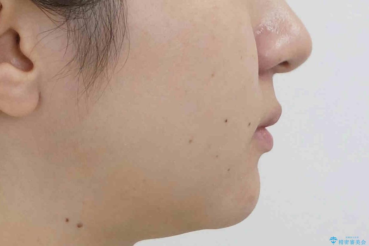 他3軒で4本抜いてワイヤー矯正と言われた 1本の抜歯でマウスピース矯正で治療可能ですの治療後(顔貌)