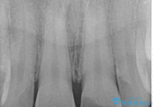 酔っ払ってぶつけた前歯 オールセラミッククラウンで自然な前歯にの治療前