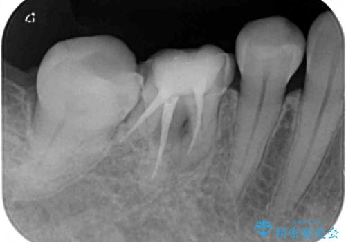 クラウンが外れたままの奥歯 オールセラミッククラウン補綴治療の治療前