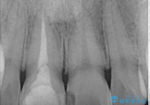 事故でぶつけてから変色した前歯 オールセラミッククラウン補綴治療の治療前