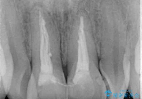 前歯をキレイにしたい ジルコニアクラウンでの治療の治療前