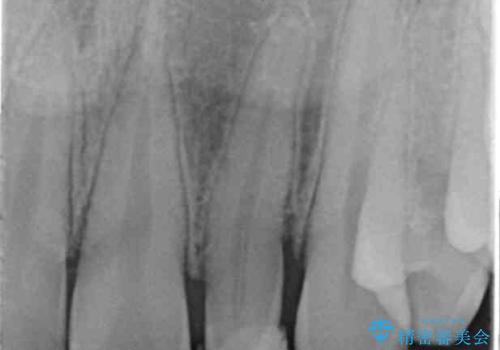 変色した前歯をキレイにしたい ジルコニアクラウンでの修復の治療前