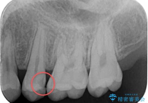 歯と歯の間の虫歯 セラミックインレーでの治療