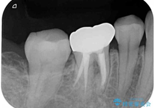 クラウンが外れたままの奥歯 オールセラミッククラウン補綴治療の治療後