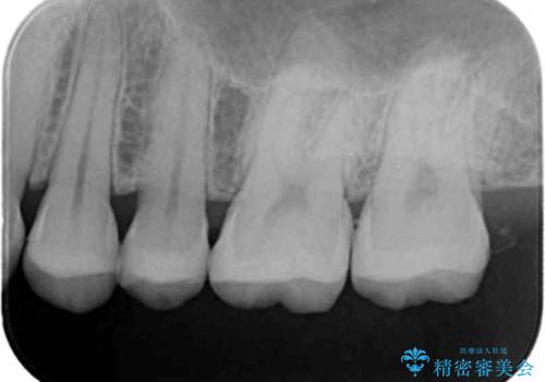 銀歯のやり替え セラミックインレーでの治療の治療後