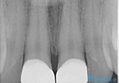 酔っ払ってぶつけた前歯 オールセラミッククラウンで自然な前歯にの治療後
