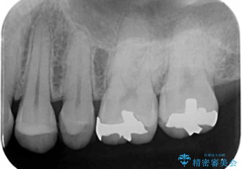 銀歯のやり替え セラミックインレーでの治療の治療前