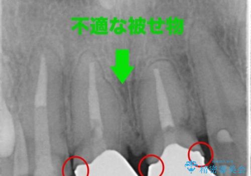 被せ物のやりかえ治療の治療中