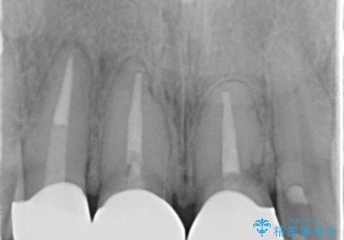 被せ物のやりかえ治療の治療後