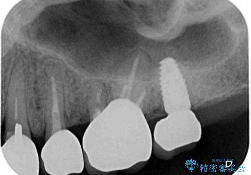 割れてしまった奥歯 インプラントによる補綴治療の治療後
