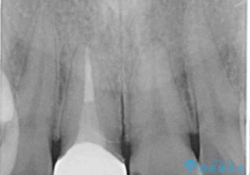 事故でぶつけてから変色した前歯 オールセラミッククラウン補綴治療の治療後