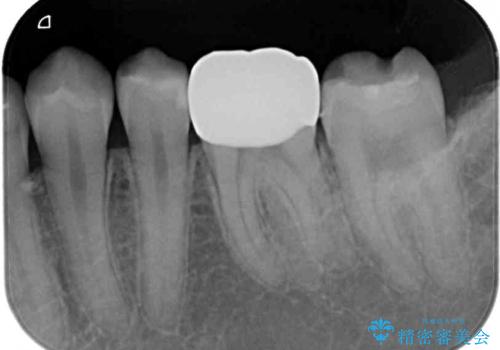 度重なる処置でつぎはぎだらけ オールセラミッククラウンによる補綴治療の治療後