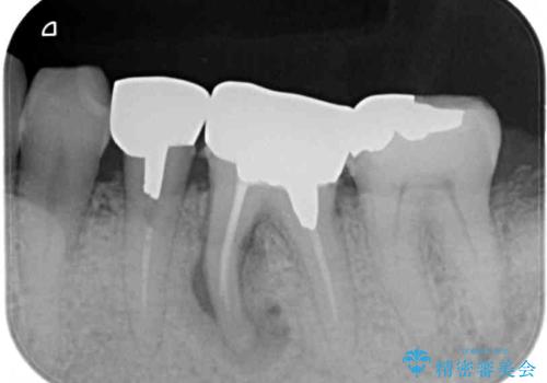 割れてしまった奥歯 インプラントによる補綴治療の治療前