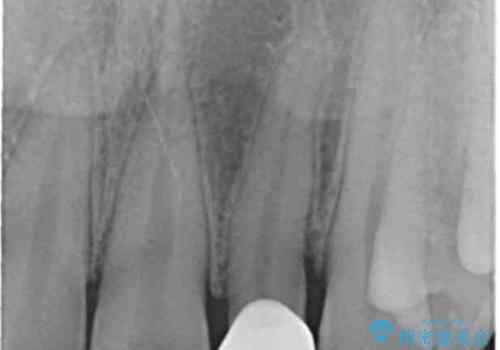 変色した前歯をキレイにしたい ジルコニアクラウンでの修復の治療後