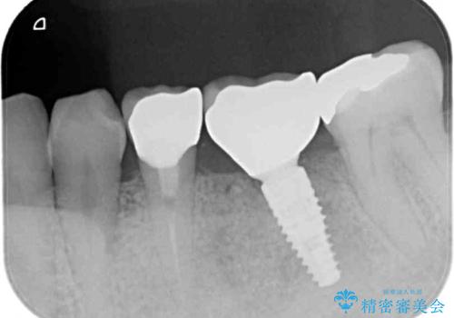 割れてしまった奥歯 インプラントによる補綴治療の治療後