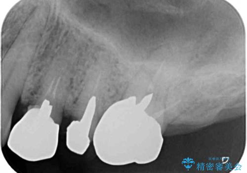 割れてしまった奥歯 インプラントによる補綴治療の治療前
