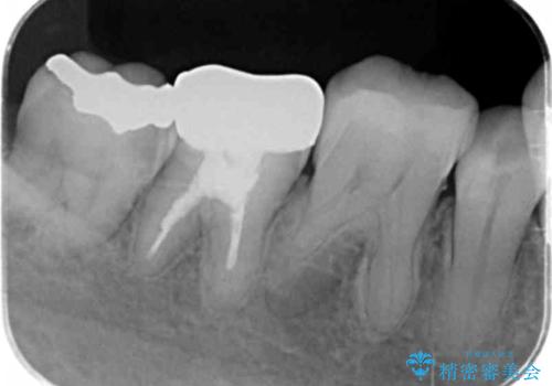 歯がかけた セラミックインレーでの治療の治療後