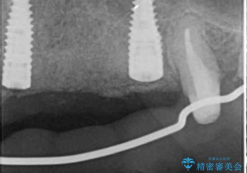 骨造成を行ったインプラント治療の治療中