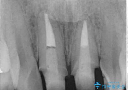 前歯をキレイにしたい ジルコニアクラウンでの治療の治療中