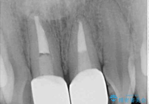 前歯をキレイにしたい ジルコニアクラウンでの治療の治療後