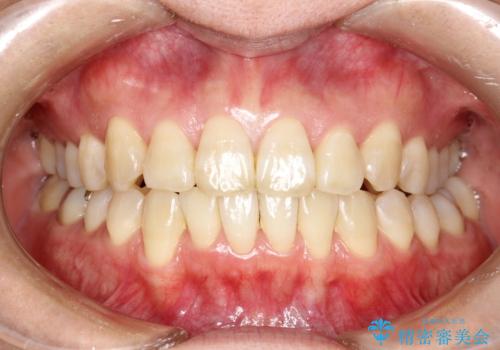 インビザラインによる矯正治療(非抜歯)　前歯の突出と上下の歯並びのガタつきの改善の治療後
