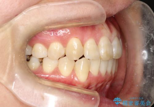 インビザラインによる矯正治療(非抜歯) 前歯の突出と上下の歯並びのガタつきの改善の治療後