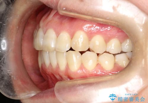 インビザラインによる矯正治療(非抜歯) 前歯の突出と上下の歯並びのガタつきの改善の治療後