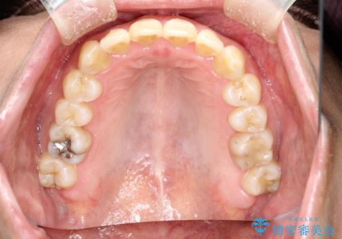 インビザラインによる矯正治療(非抜歯) 前歯の突出と上下の歯並びのガタつきの改善の治療後