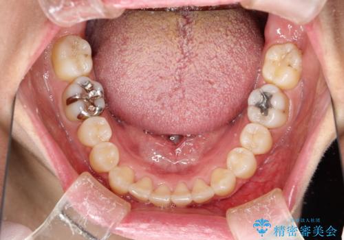 インビザラインによる矯正治療(非抜歯) 前歯の突出と上下の歯並びのガタつきの改善の治療後