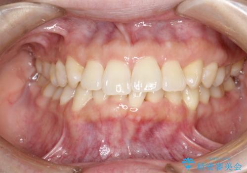 インビザライン ライトパッケージによる部分矯正治療　下の前歯のみの歯並び改善の治療中