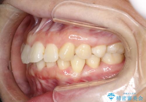 インビザライン ライトパッケージによる部分矯正治療 下の前歯のみの歯並び改善の治療中