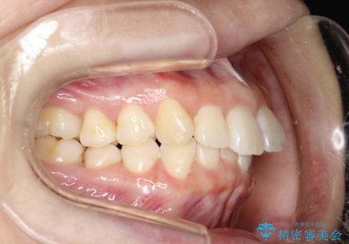 インビザライン ライトパッケージによる部分矯正治療 下の前歯のみの歯並び改善の治療中