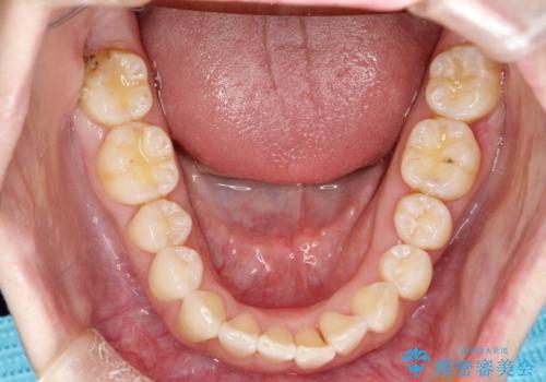 インビザライン ライトパッケージによる部分矯正治療　下の前歯のみの歯並び改善の治療中