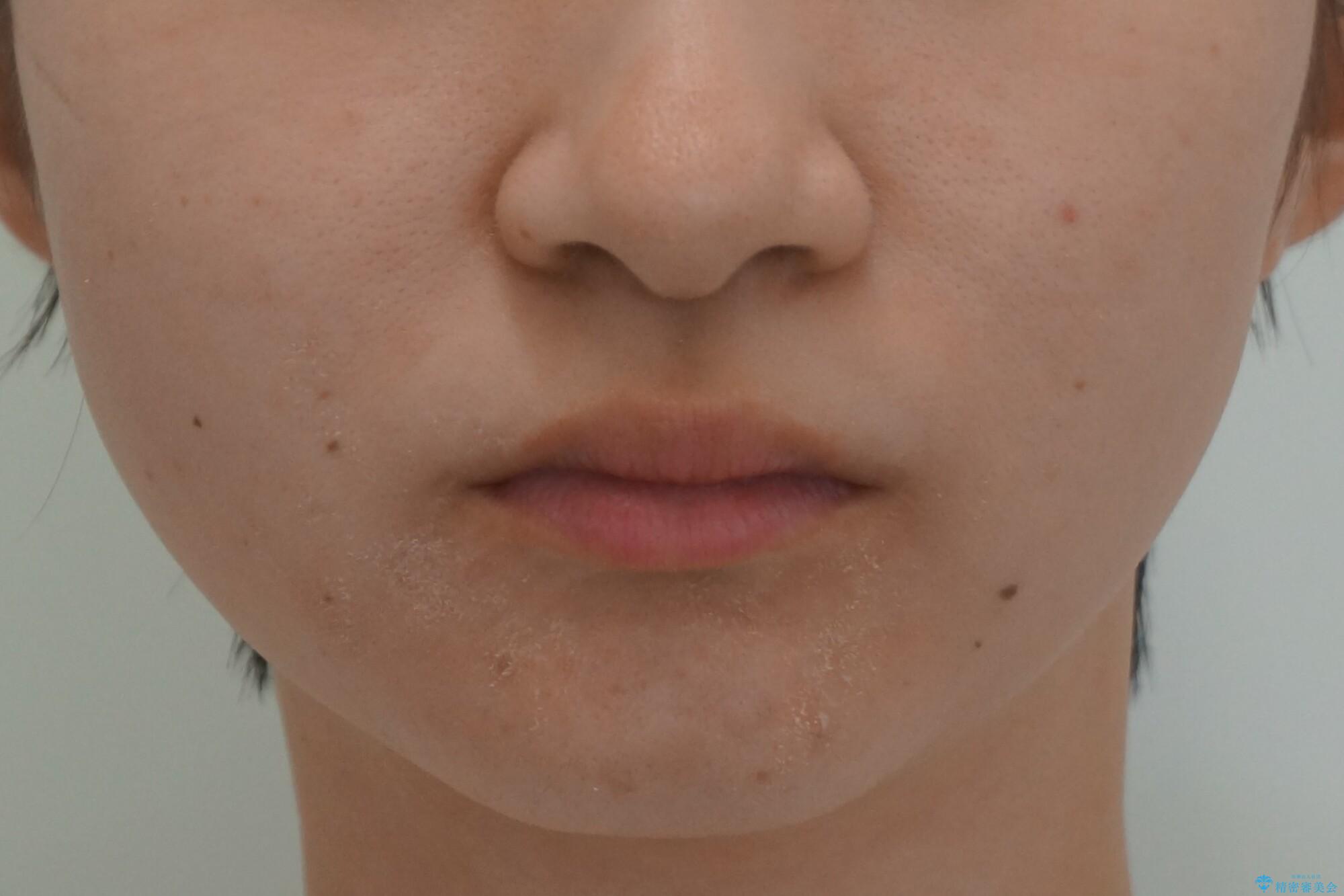 他3軒で4本抜いてワイヤー矯正と言われた 1本の抜歯でマウスピース矯正で治療可能ですの治療前(顔貌)