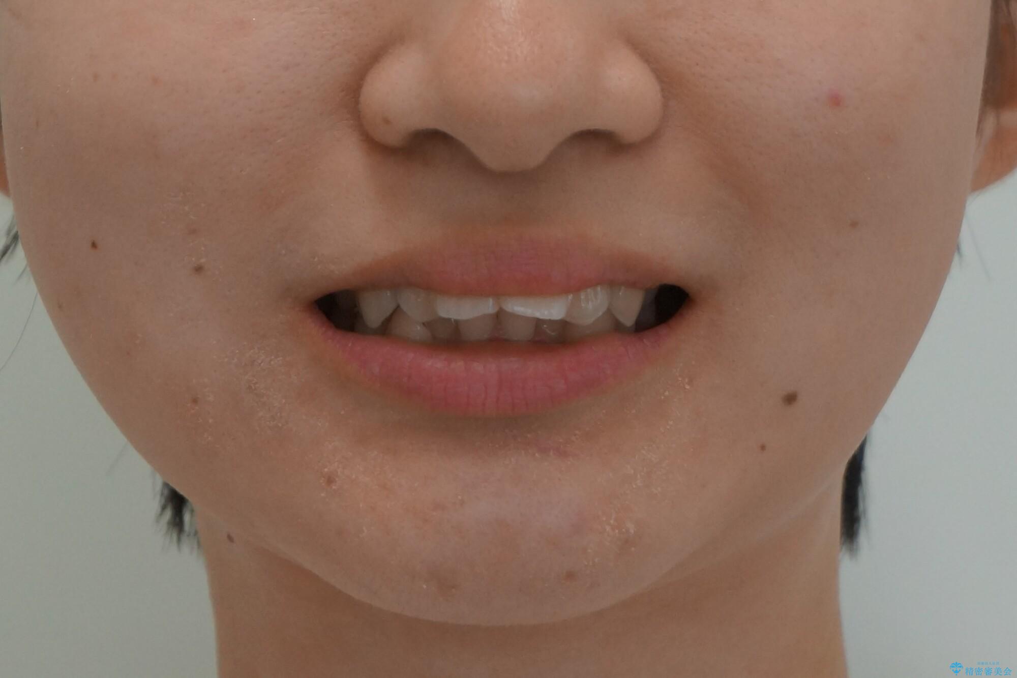 他3軒で4本抜いてワイヤー矯正と言われた 1本の抜歯でマウスピース矯正で治療可能ですの治療前(顔貌)