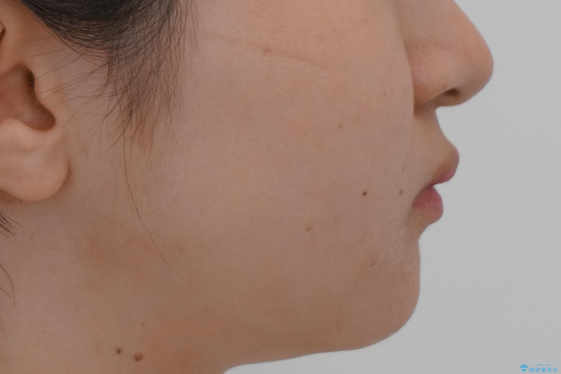 他3軒で4本抜いてワイヤー矯正と言われた 1本の抜歯でマウスピース矯正で治療可能ですの治療前(顔貌)