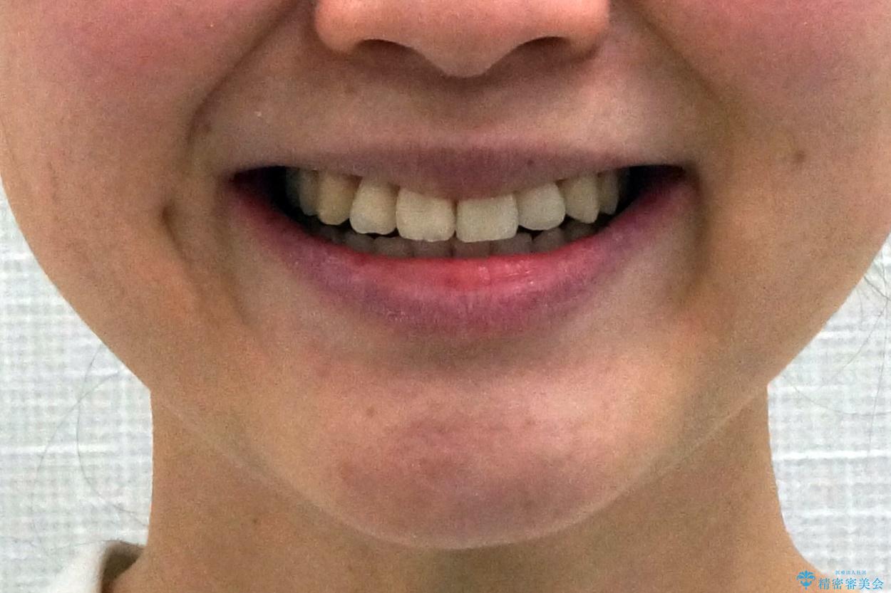 前歯がねじれている　奥歯を後ろに下げて歯を抜かずに並べましたの治療後（顔貌）