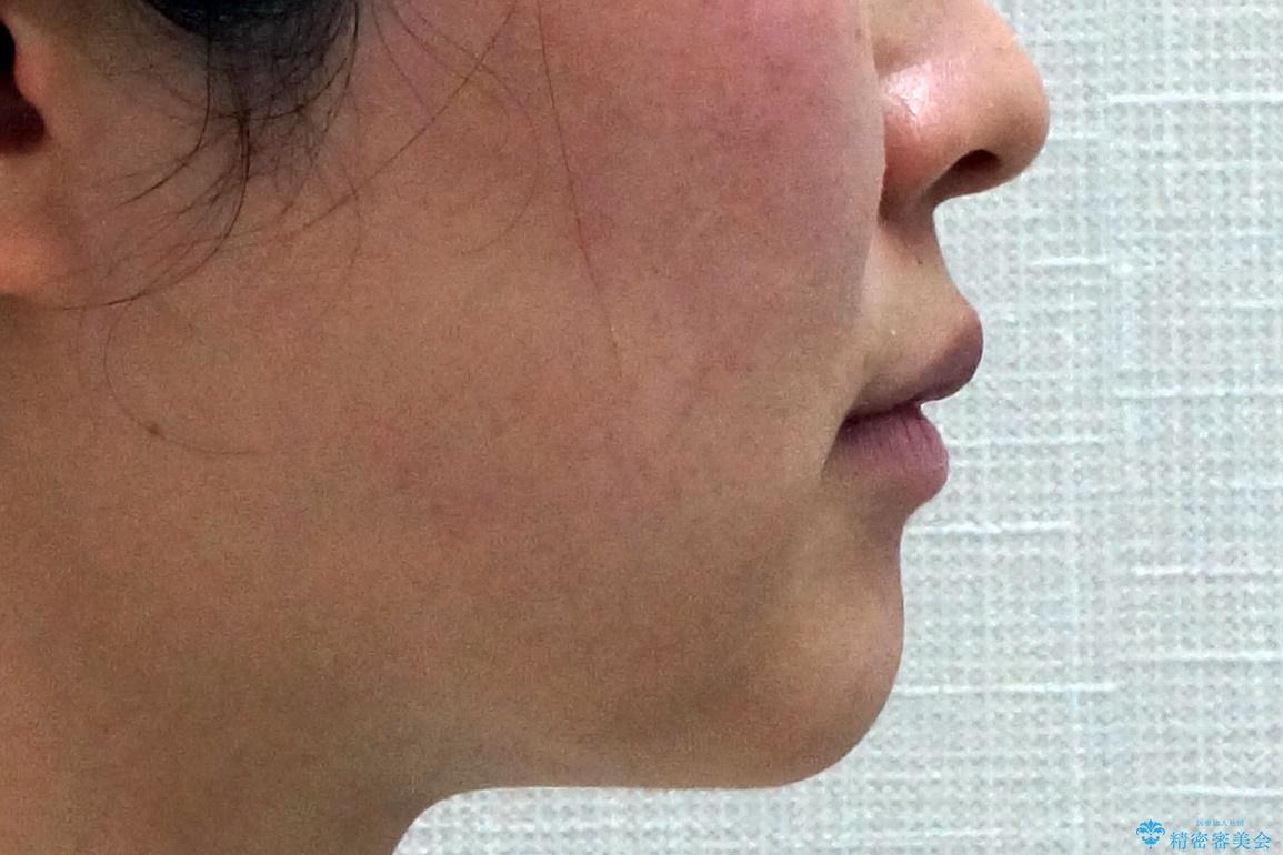 前歯がねじれている 奥歯を後ろに下げて歯を抜かずに並べましたの治療後(顔貌)