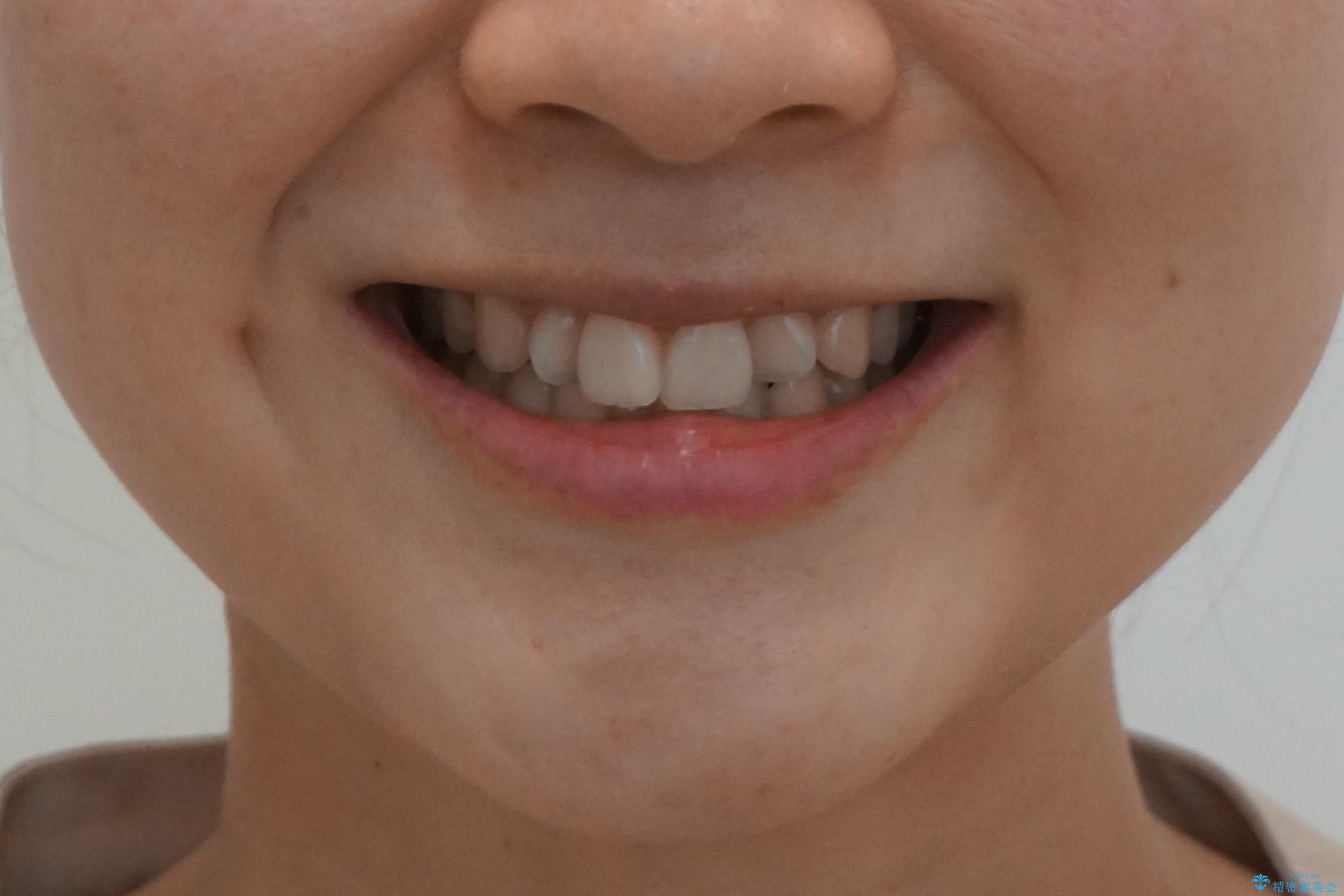 前歯がねじれている　奥歯を後ろに下げて歯を抜かずに並べましたの治療前（顔貌）