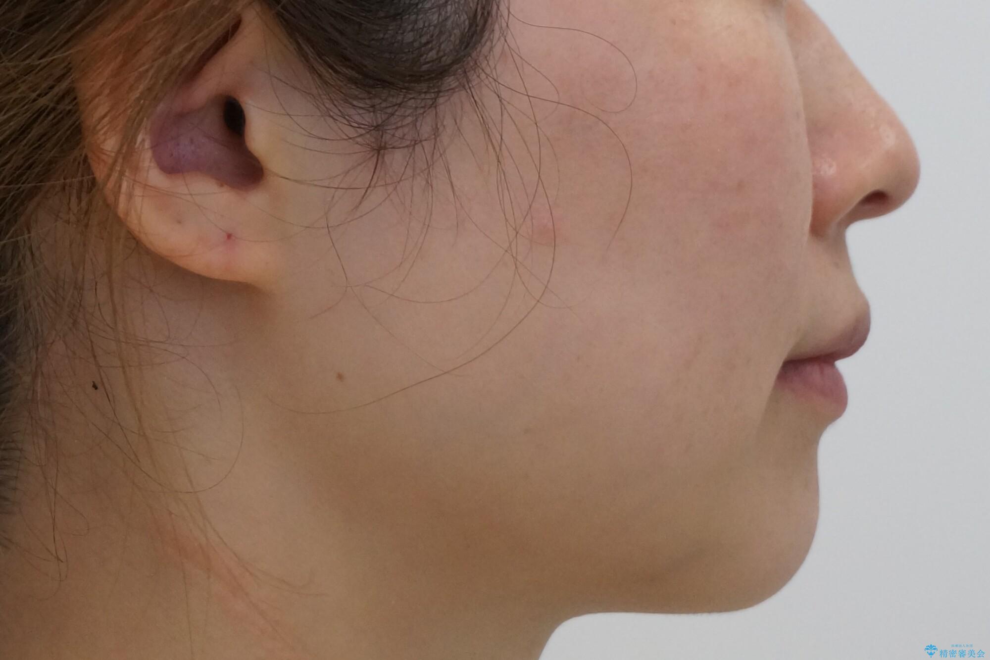 前歯がねじれている 奥歯を後ろに下げて歯を抜かずに並べましたの治療前(顔貌)