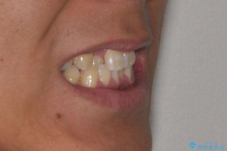 マウスピース矯正で素敵な笑顔に変身!前歯のガタツキを治しましたの治療前(顔貌)