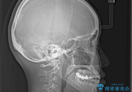 前歯のデコボコをすっきりと インビザライン矯正の治療前