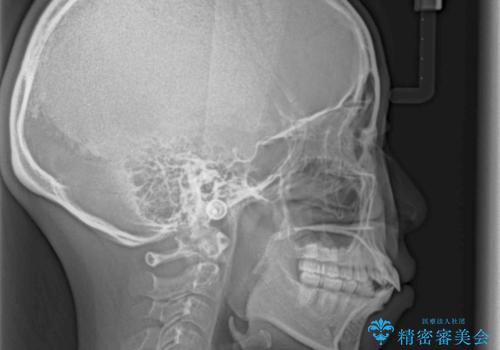 横顔の印象が大きく変わる ワイヤー装置での抜歯矯正の治療前