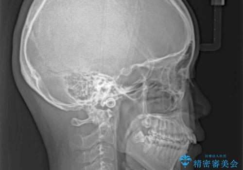 飛び出した上顎前歯 インビザラインで引っ込めるの治療前