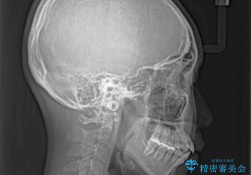 口が閉じにくい ワイヤー装置での抜歯矯正の治療前