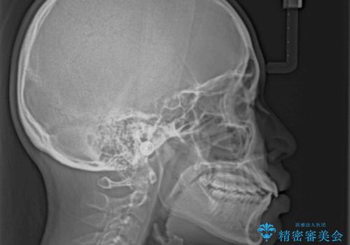 ワイヤー装置の抜歯矯正で横顔のシルエットをすっきりとの治療前